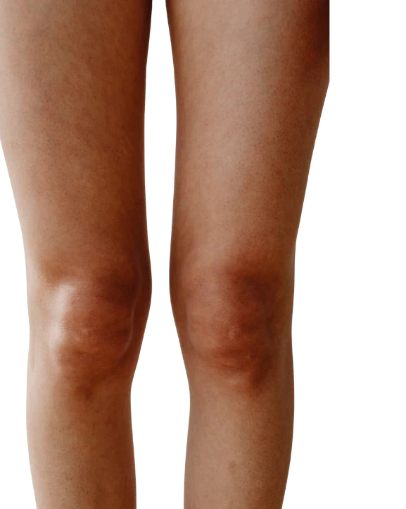Edema & Swelling